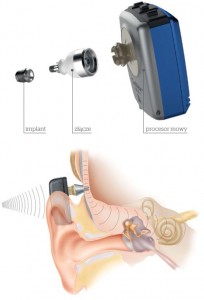 System Cochlear™ BAHA Connect – schemat i mocowanie © Cochlear